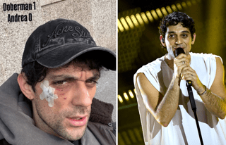 Bresh ferito al volto da un Dobermann, come sta il cantante