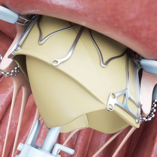 Orgoglio torinese: alle Molinette impiantata per la prima volta al mondo una protesi al cuore &quot;speciale&quot;