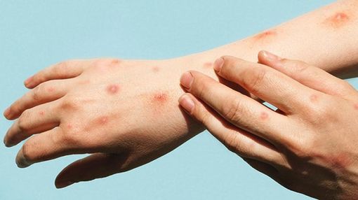 Vaiolo delle scimmie, monta la polemica Vaiolo delle scimmie, monta la polemica