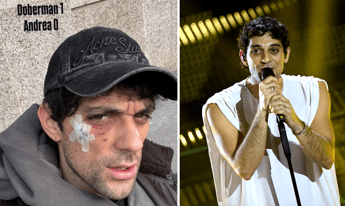 Bresh ferito al volto da un Dobermann, come sta il cantante