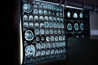 Uno spray nasale ferma l'invecchiamento del cervello, lo studio Uno spray nasale ferma l'invecchiamento del cervello, lo studio