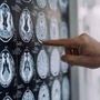 Stop tremori Parkinson senza bisturi, 10 pazienti curati con ultrasuoni a Napoli Stop tremori Parkinson senza bisturi, 10 pazienti curati con ultrasuoni a Napoli