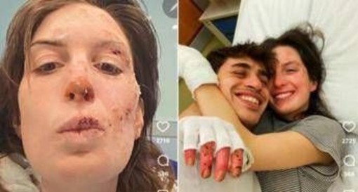 Crans-Montana, oggi dimessi due ragazzi. Eleonora Palmieri mostra le ustioni sui social