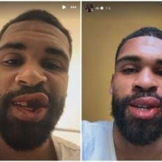 Loftus-Cheek, intervento riuscito alla mascella. E mostra foto dopo scontro in Milan-Parma Loftus-Cheek, intervento riuscito alla mascella. E mostra foto dopo scontro in Milan-Parma