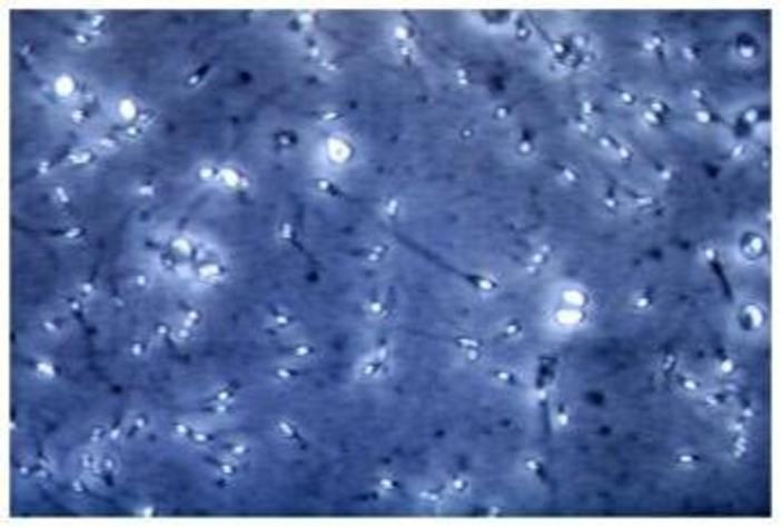 Microplastiche nella prostata e nel liquido seminale, la scoperta italiana: cosa comporta